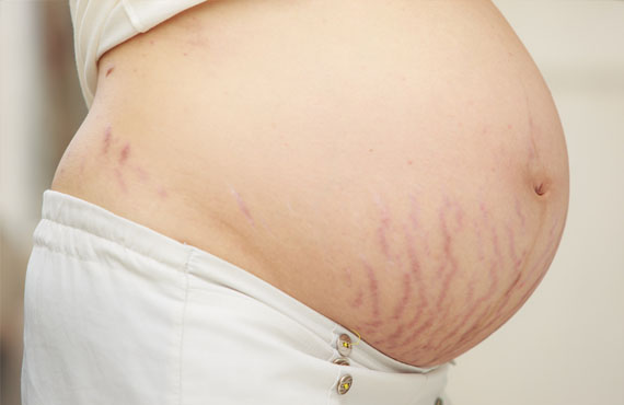 Cách khắc phục những thay đổi về làn da của mẹ trong quá trình mang thai